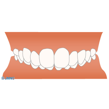 上顎前突（出っ歯）