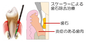 歯周病治療イメージ