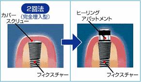 2回法